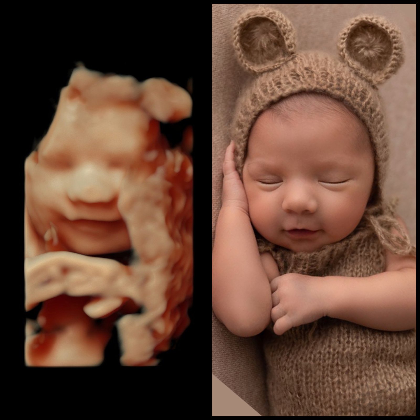 Ultrasound image beside the newborn photo it predicted