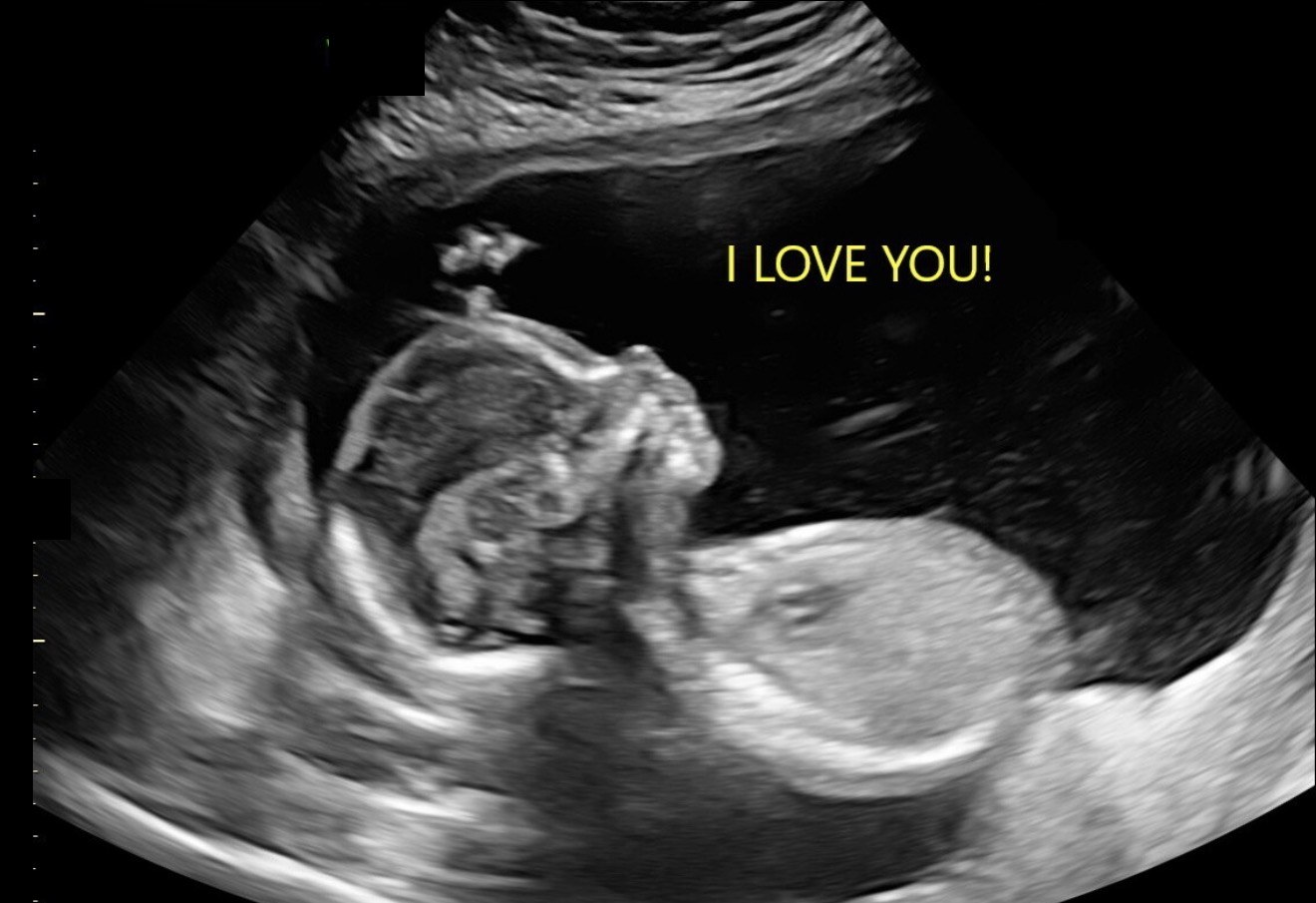 2D ultrasound image with 'I love you!' message