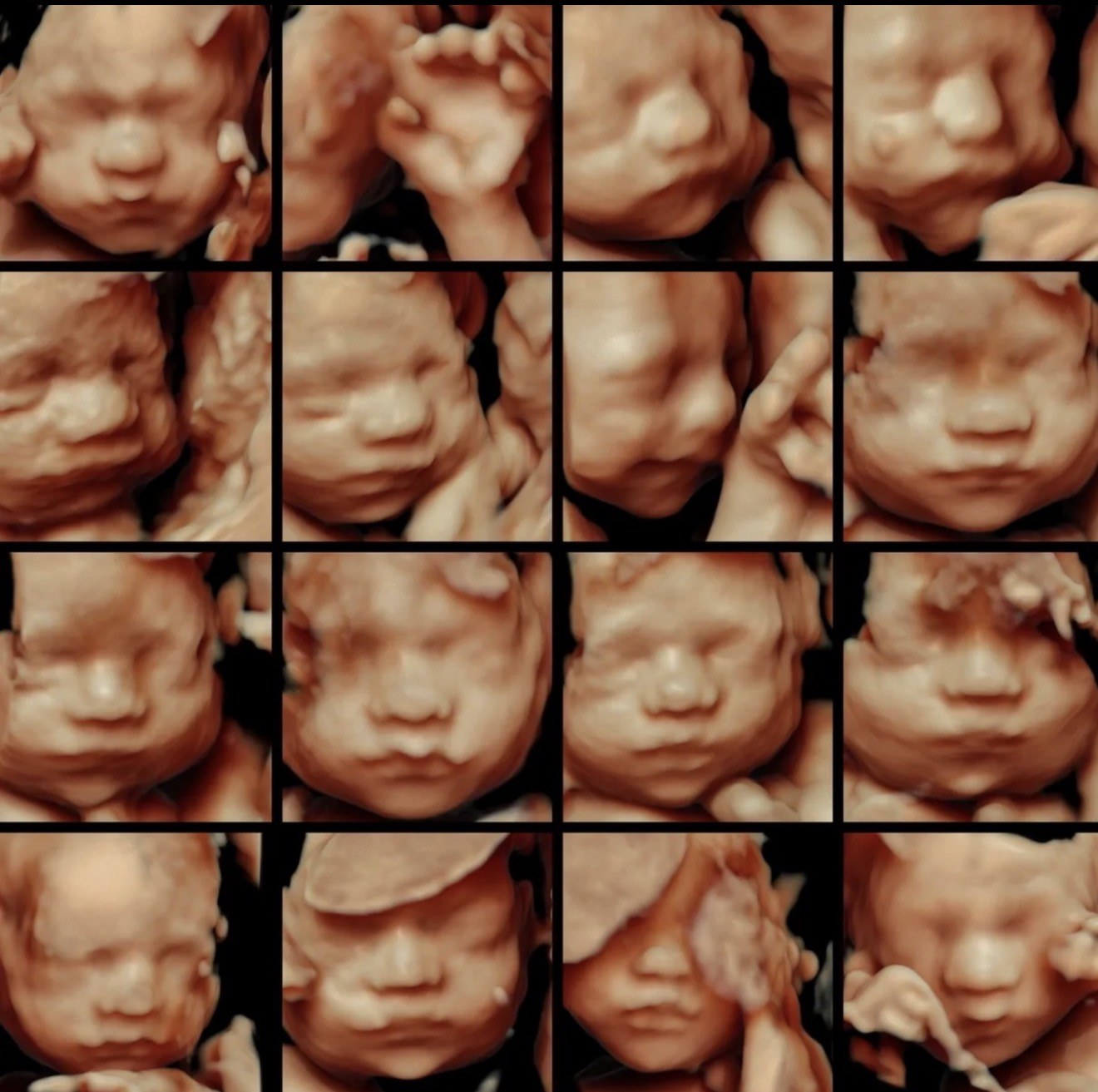 Stunning 3D, 4D, and 5D ultrasound portraits
