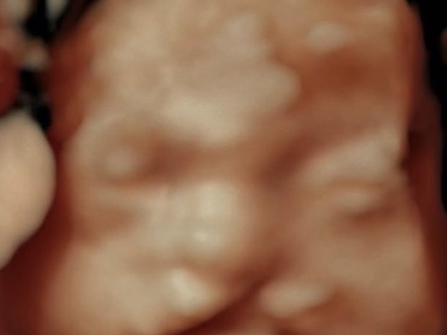 3D ultrasound image of a baby's face
