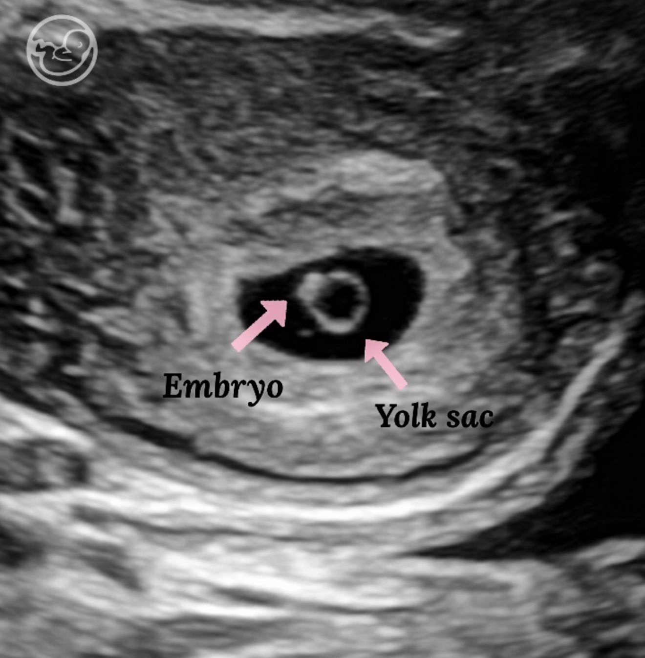 Early pregnancy ultrasound showing embryo and yolk sac